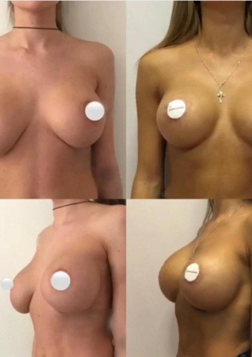 Beautiful breasts with implants