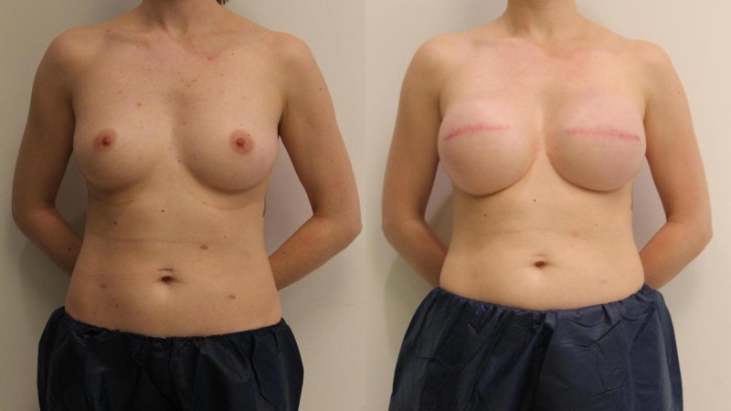 Breast plastic