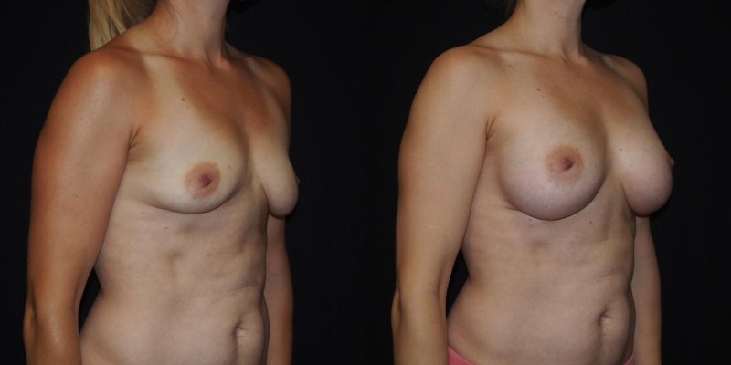 Breasts of a woman who gives birth