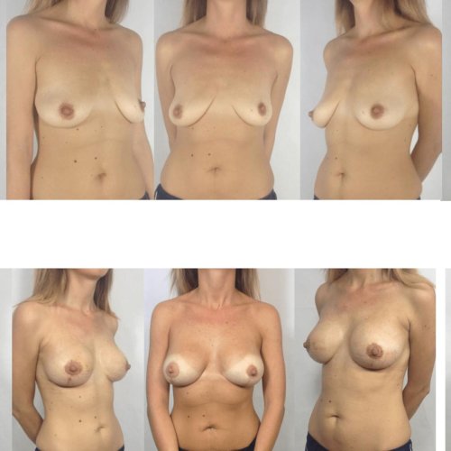 Breast enlargement