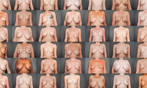 Breast plastic
