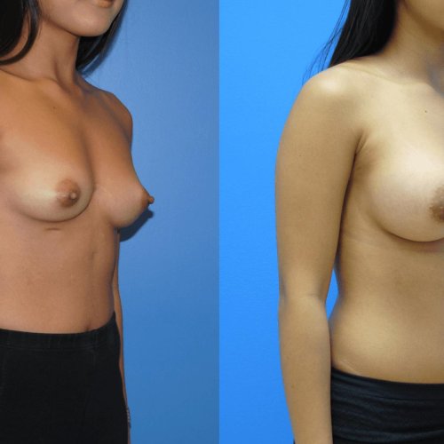 Elocated female breast