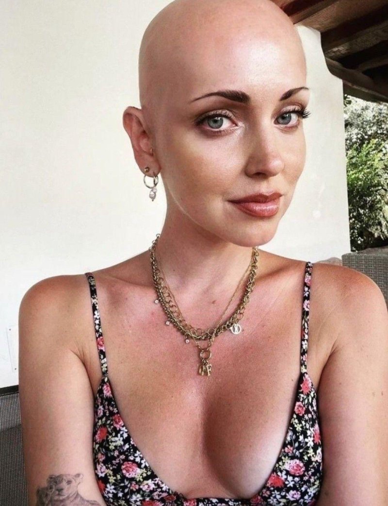 Kate Flanneri shaved bald