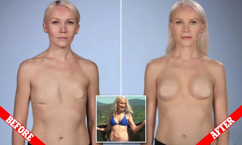 Mastectomy porn actresses