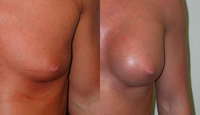 Klainfelter gynecomastia