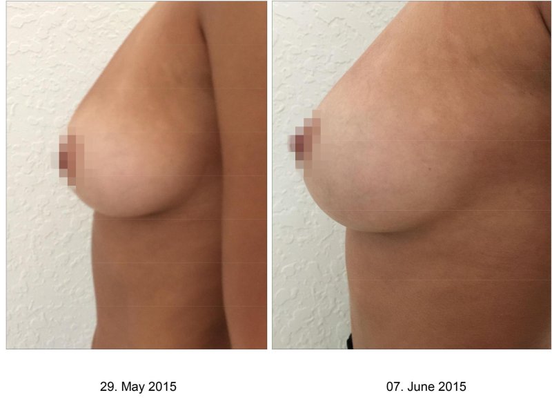Breasts after surgery