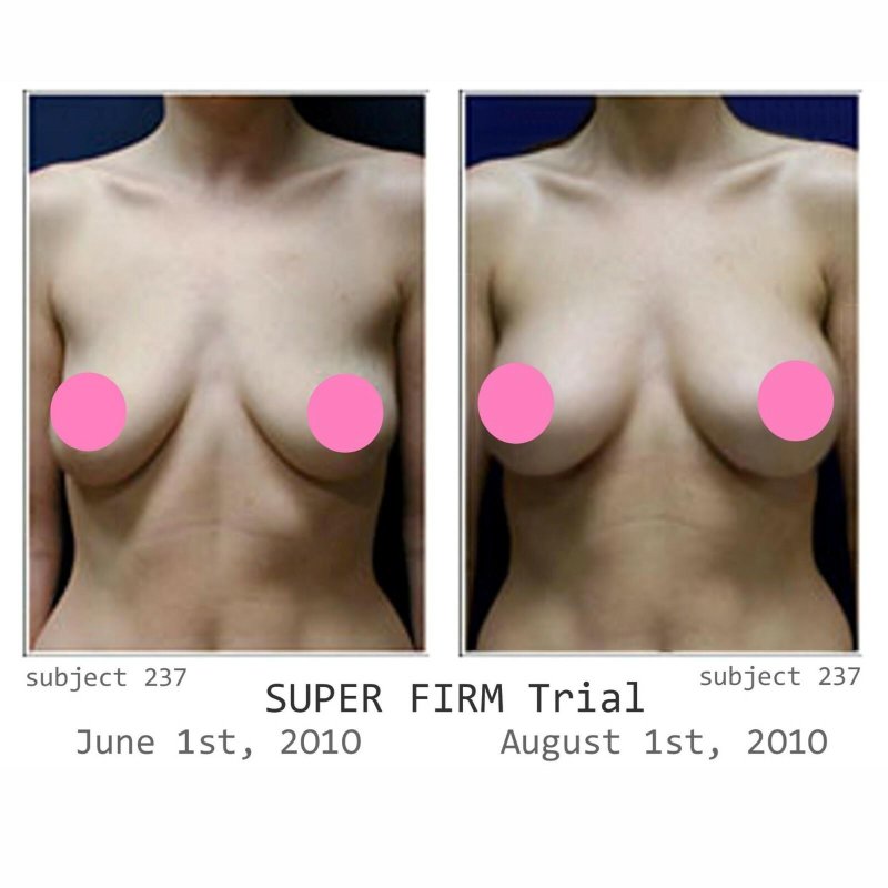 Breast augmentation