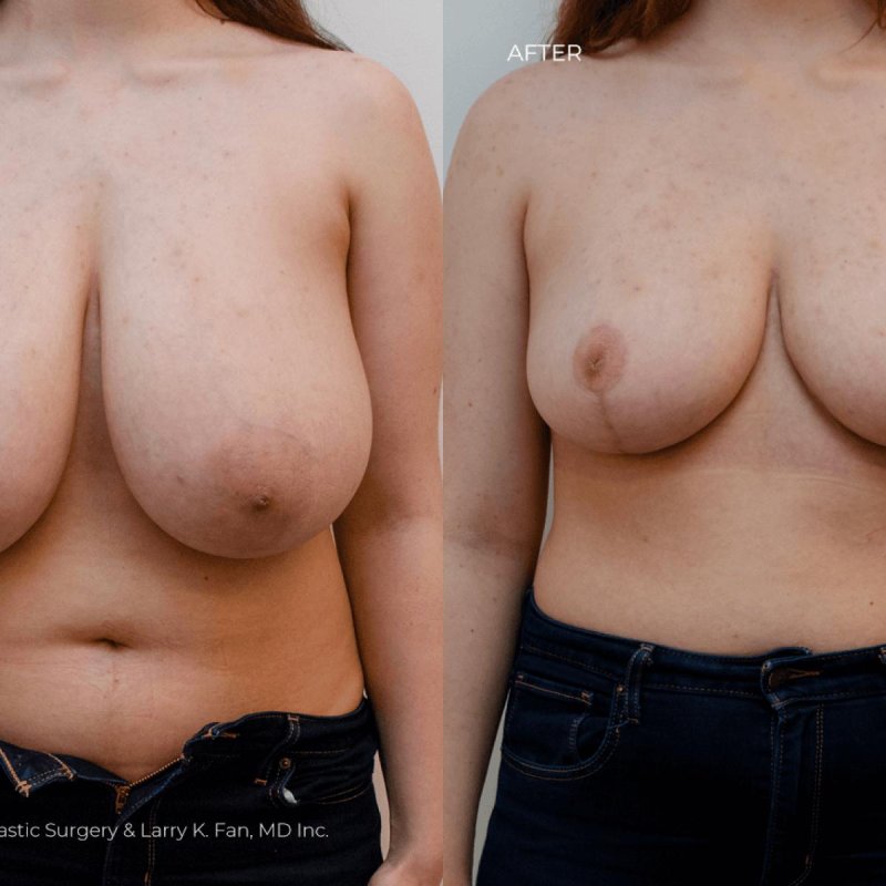 Breast augmentation