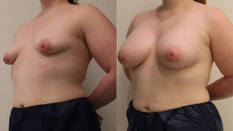 Gynecomastia stage