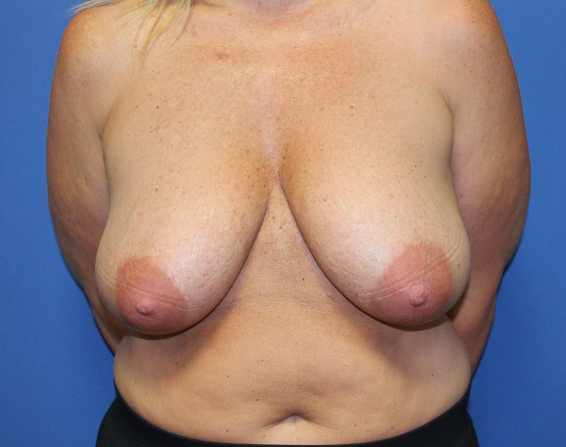 Breast reduction