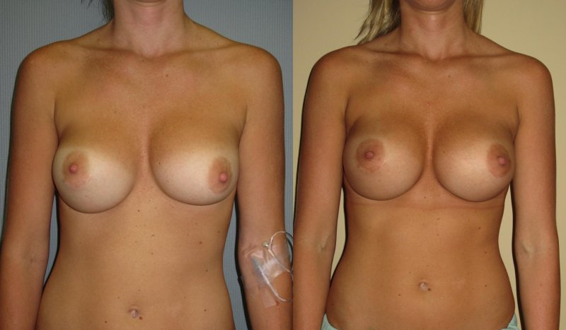 Enlarged breasts without clothes