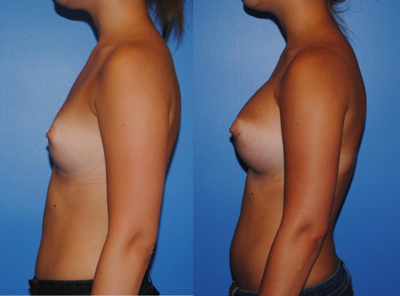 Breast enlargement