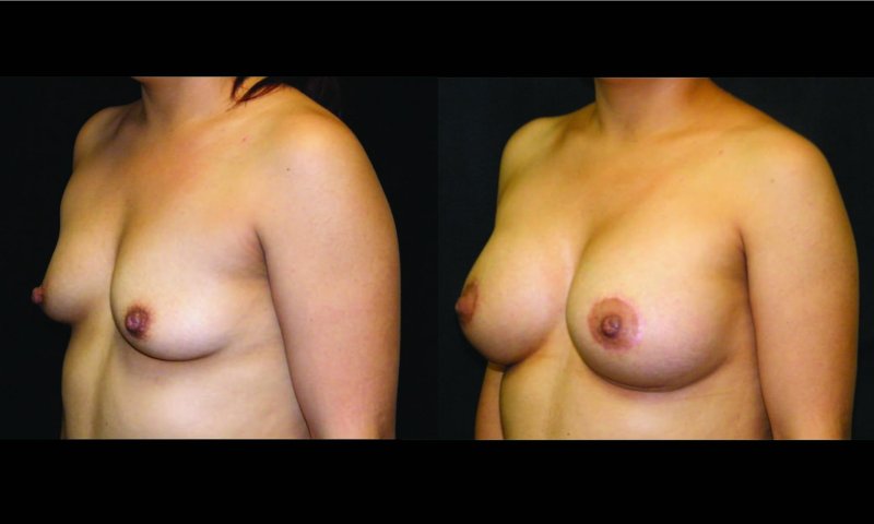 Breast plastic