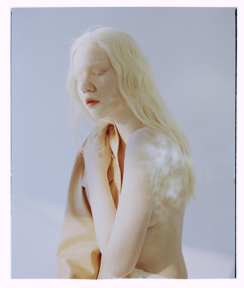Girl Albino
