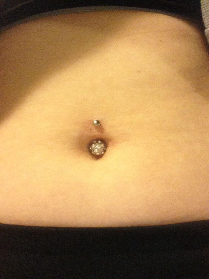 Keloid scar piercing navel