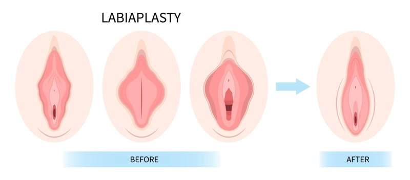 Vagina Barbie Labioplasty