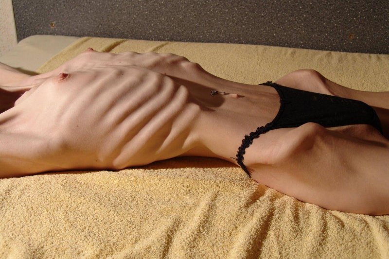 Beautiful naked anorexics