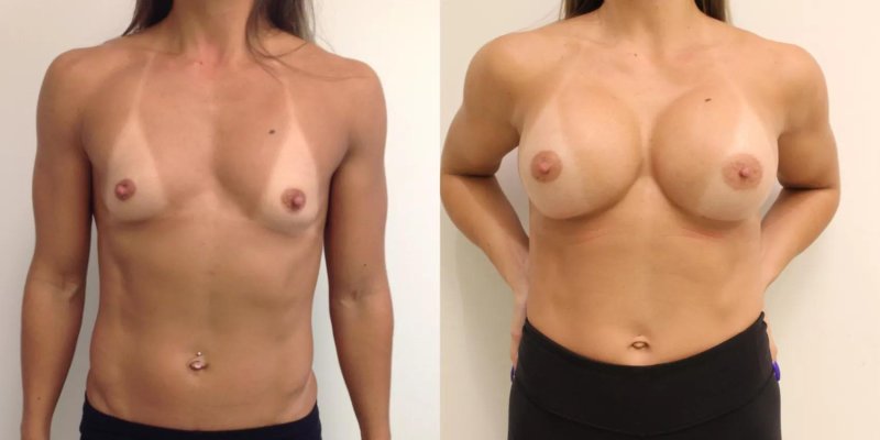 Silicone breasts before and after