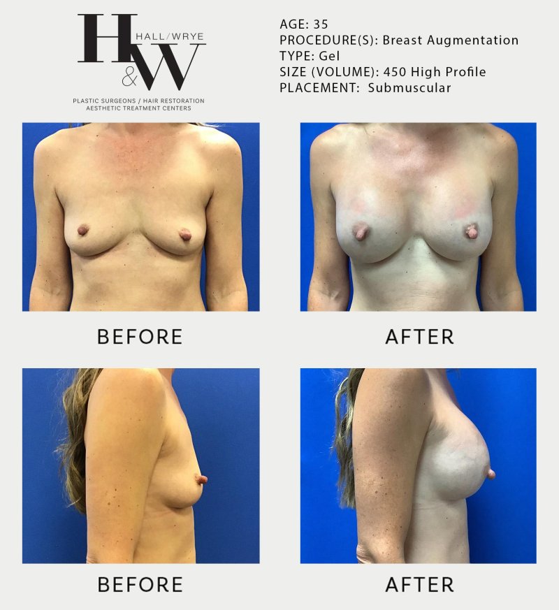 Breast enlargement with anatomical implants
