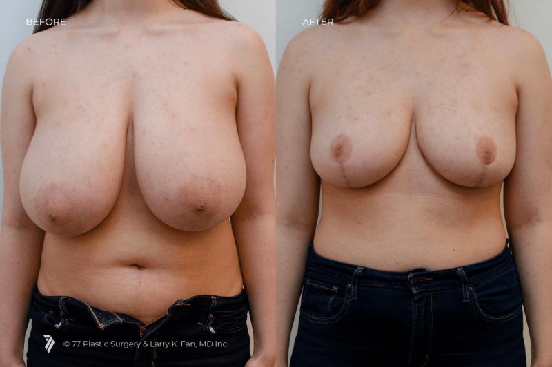 Breast plastic