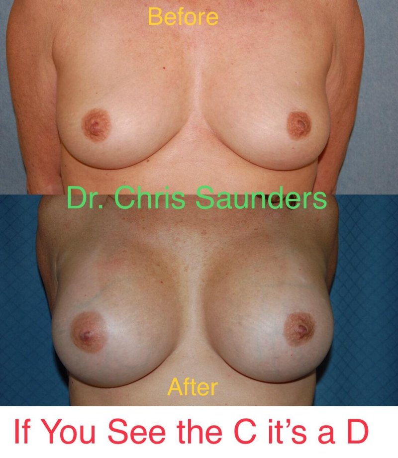 Breast augmentation