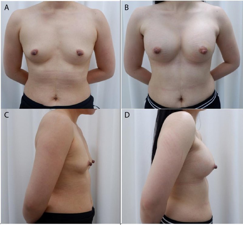 False gynecomastia