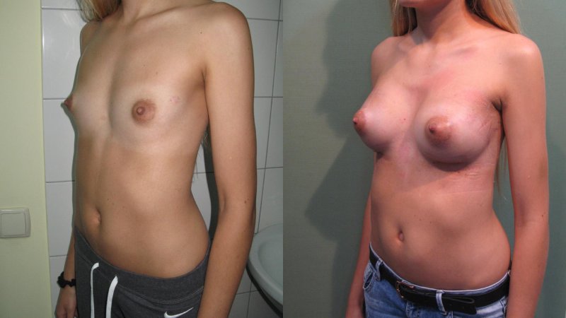 Breast plastic