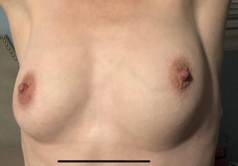 Breast plastic