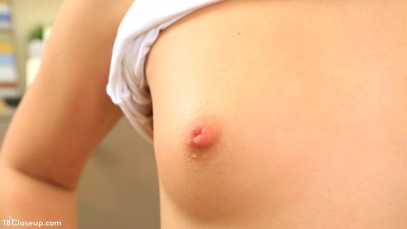 White pimple on a nipple