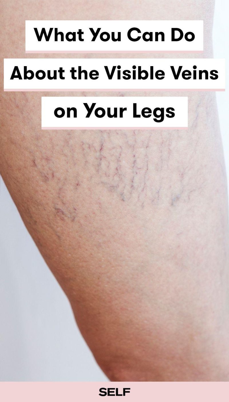 Varicose veins
