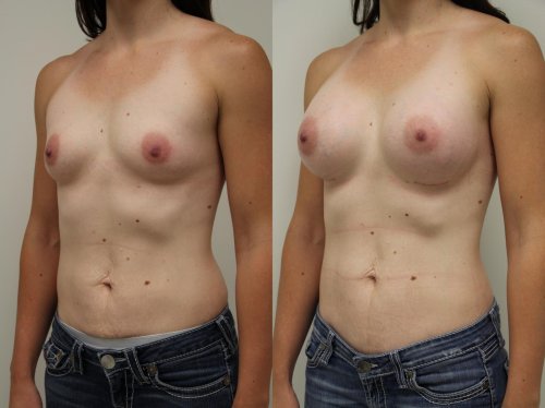 Gynecomastia liposuction