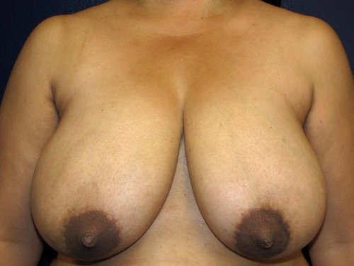 Breast reduction
