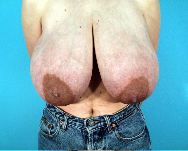 Huge ugly breasts