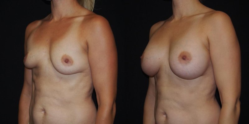 Breast plastic